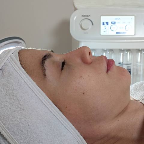 Tratamiento Indiba facial